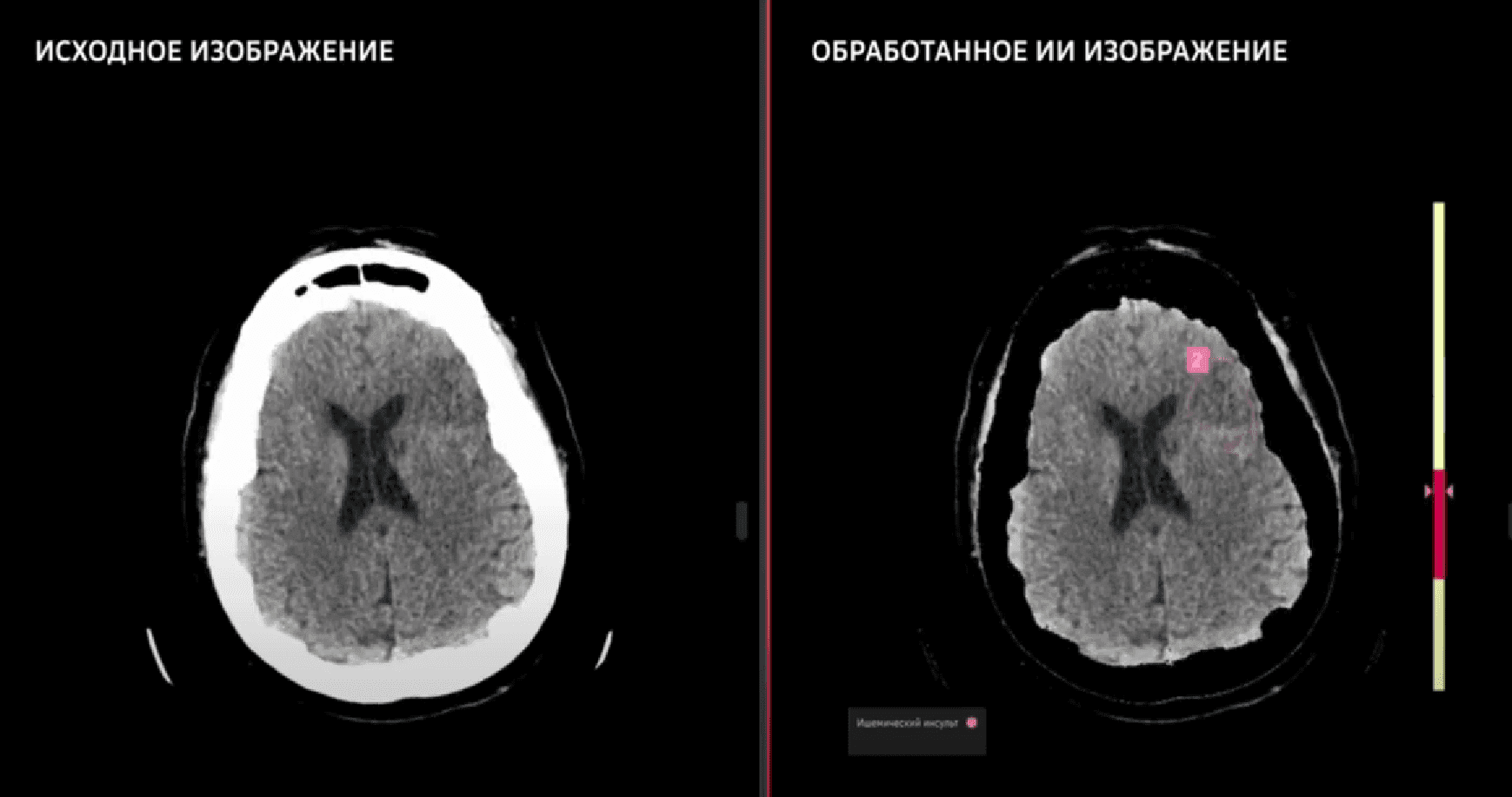 AI-сервис «КТ головного мозга» от СберМедИИ получил регистрационное  удостоверение