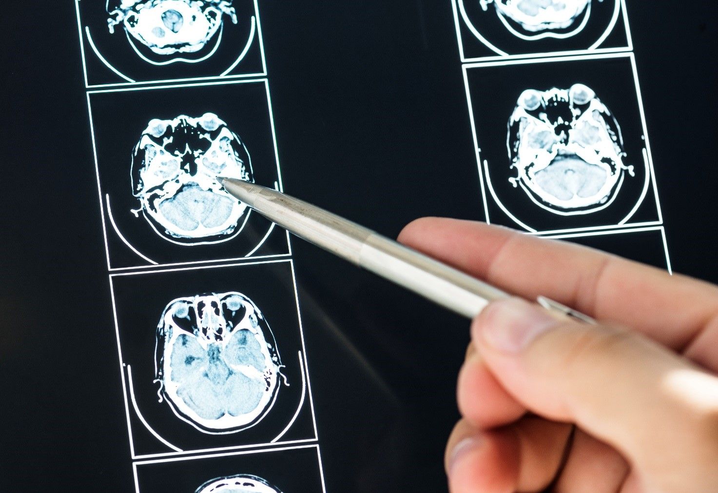 Доктор указывает ручкой на МРТ-изображение среза головного мозга